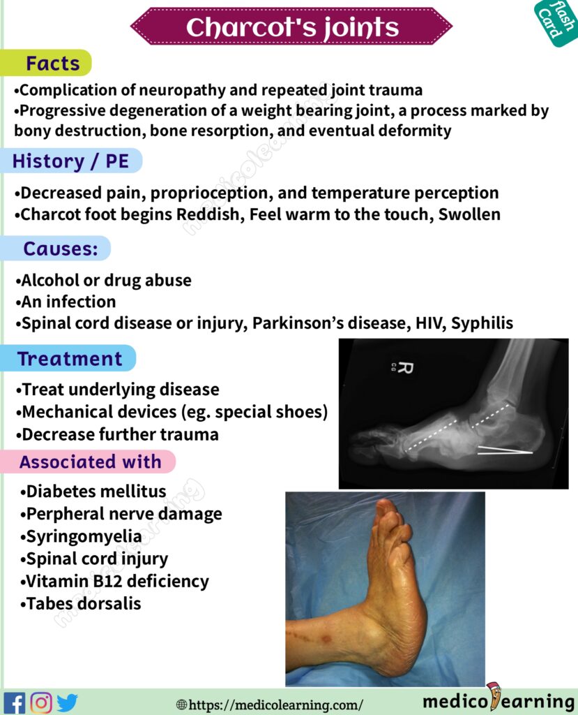 Charcot's Joints Flash Card