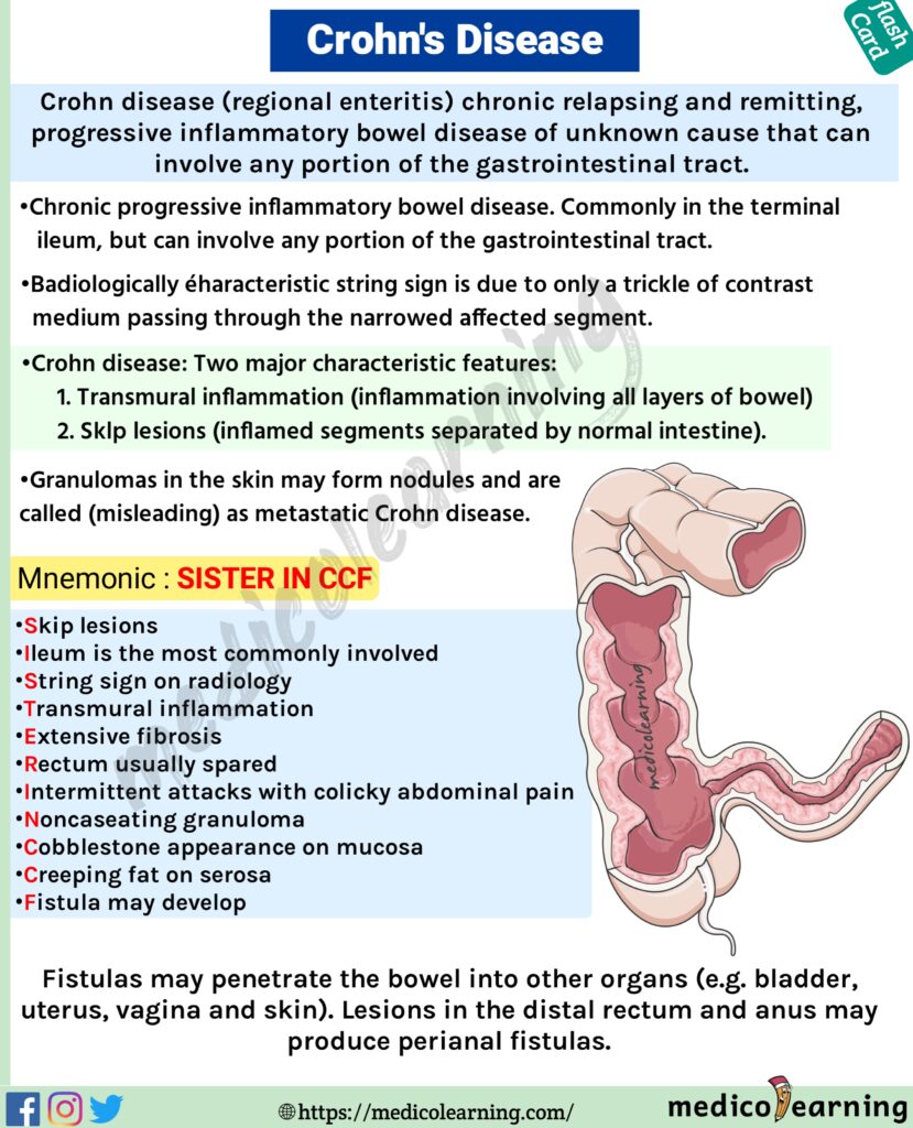 Crohn's Disease Flash Card