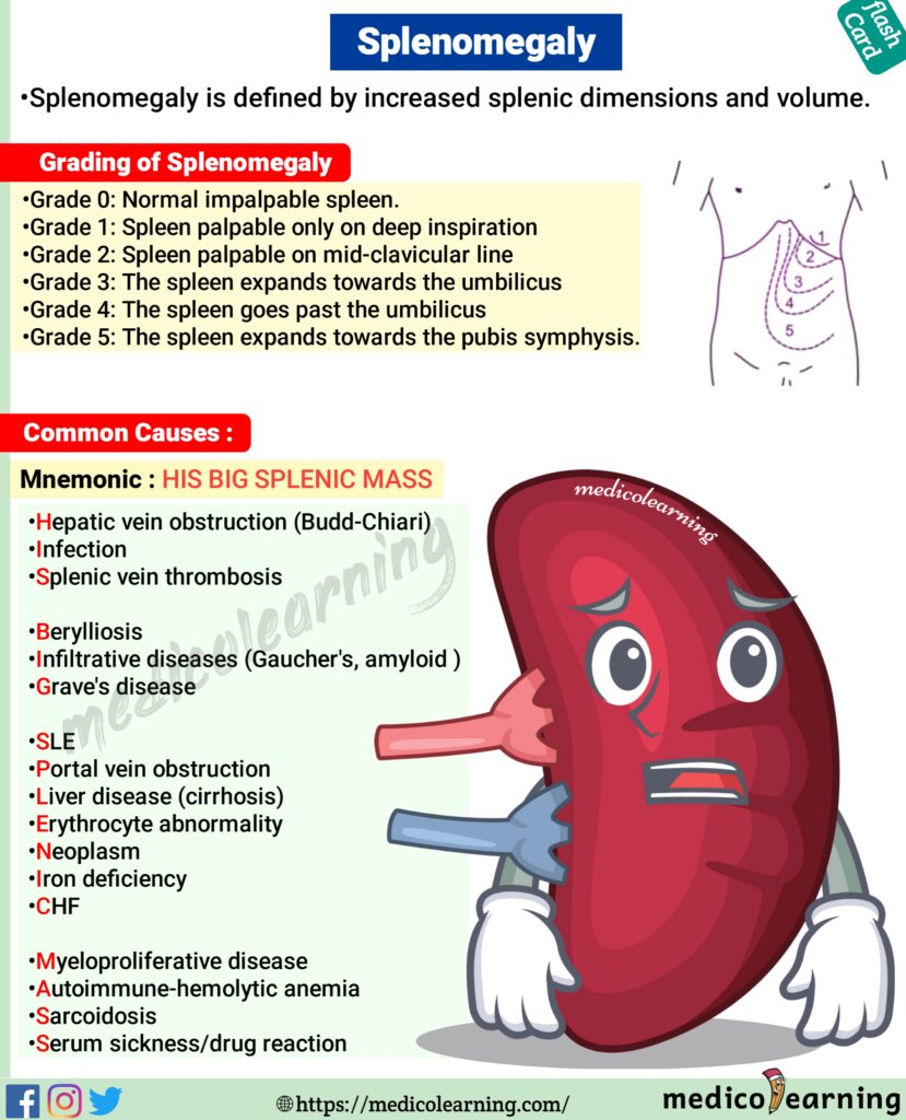 Splenomegaly Flash Card