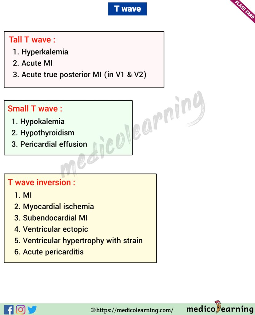 About T wave in Ecg