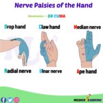 Read more about the article Nerve Palsies of Hand Mnemonic