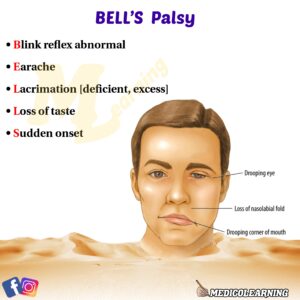 Read more about the article Bells Palsy Mnemonic
