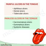 Read more about the article Ulcers Of Tongue