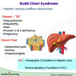 Read more about the article Budd Chiari Syndrome