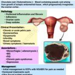 Read more about the article Chocolate Cyst (Ovarian Endometrioma )