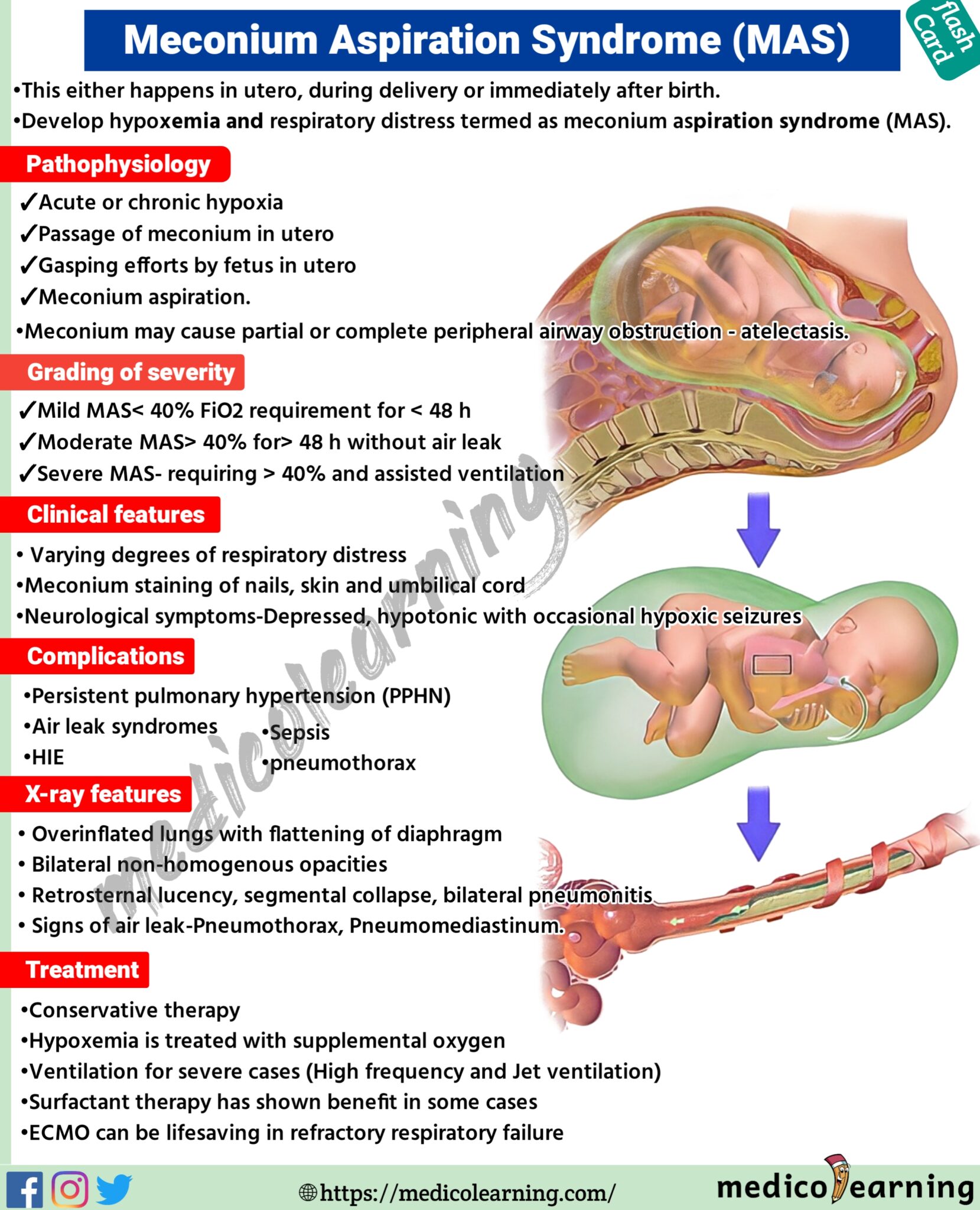 Meconium aspiration syndrome – MedicoLearning