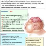 Read more about the article Anencephaly
