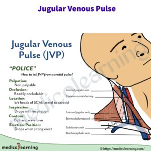 Read more about the article jugular venous pulse (JVP)