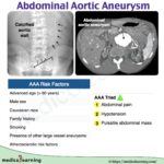Read more about the article Abdominal aortic aneurysm