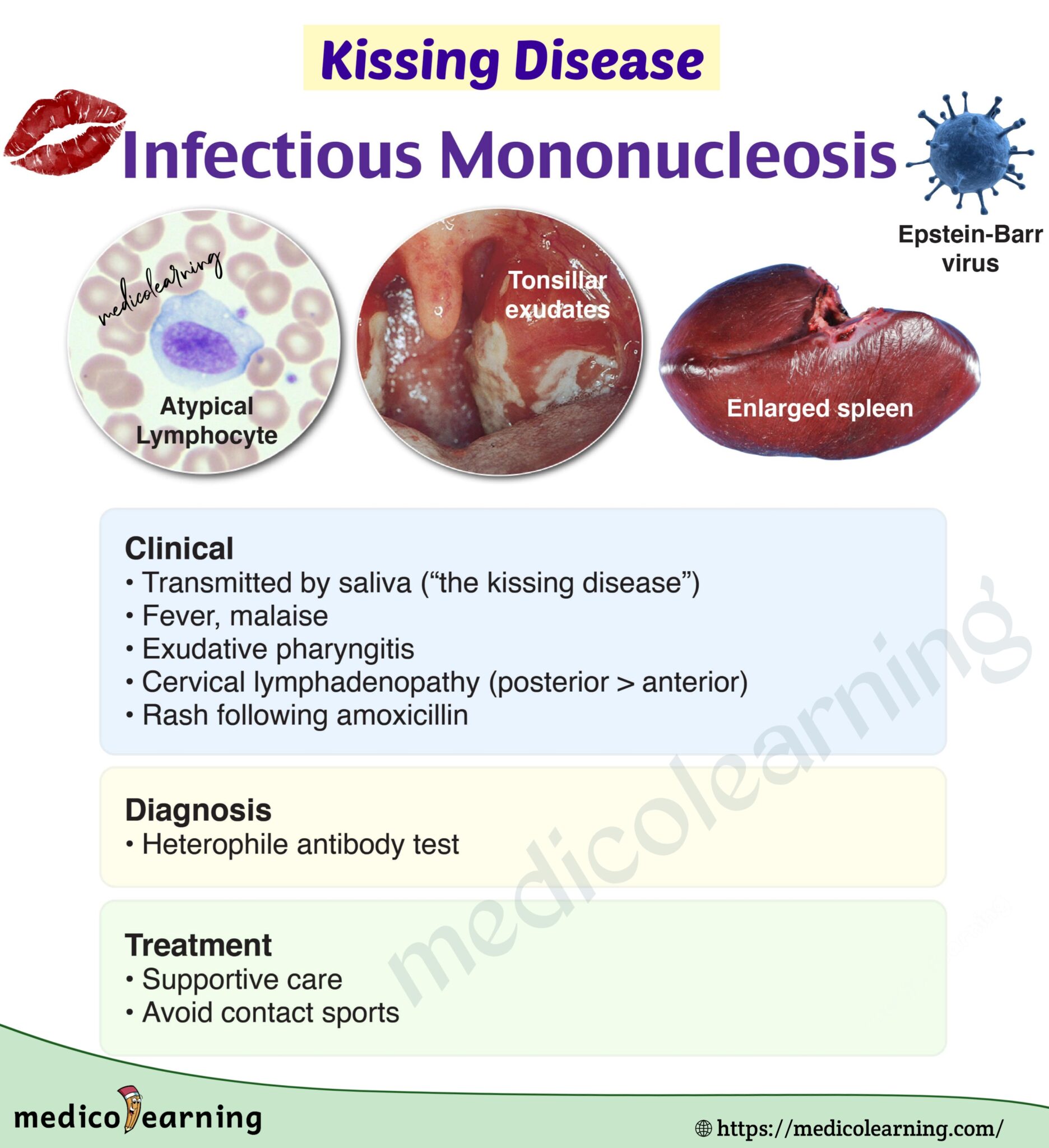 Infectious Mononucleosis Glandular Fever MedicoLearning