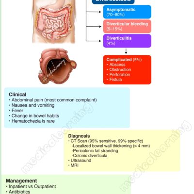 Acute diverticulitis – MedicoLearning