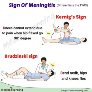 Read more about the article Meningitis