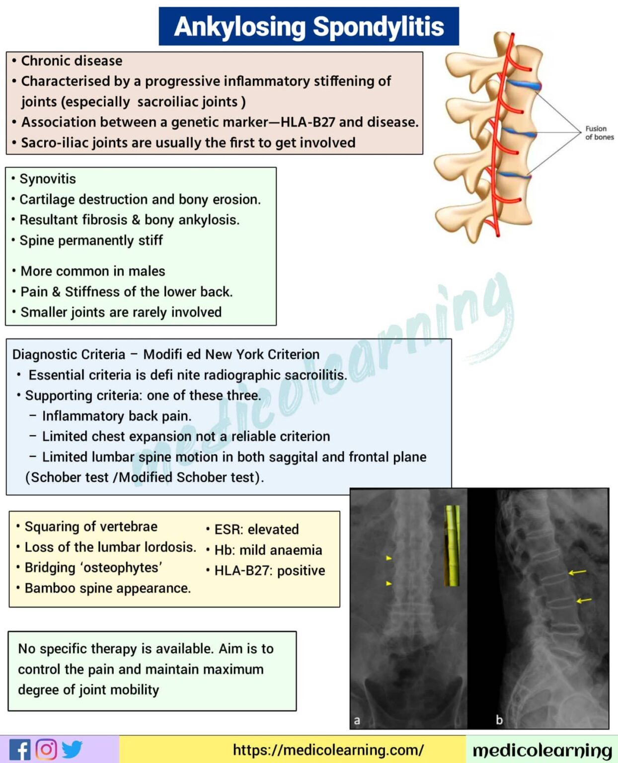 Ankylosing spondylitis - MedicoLearning