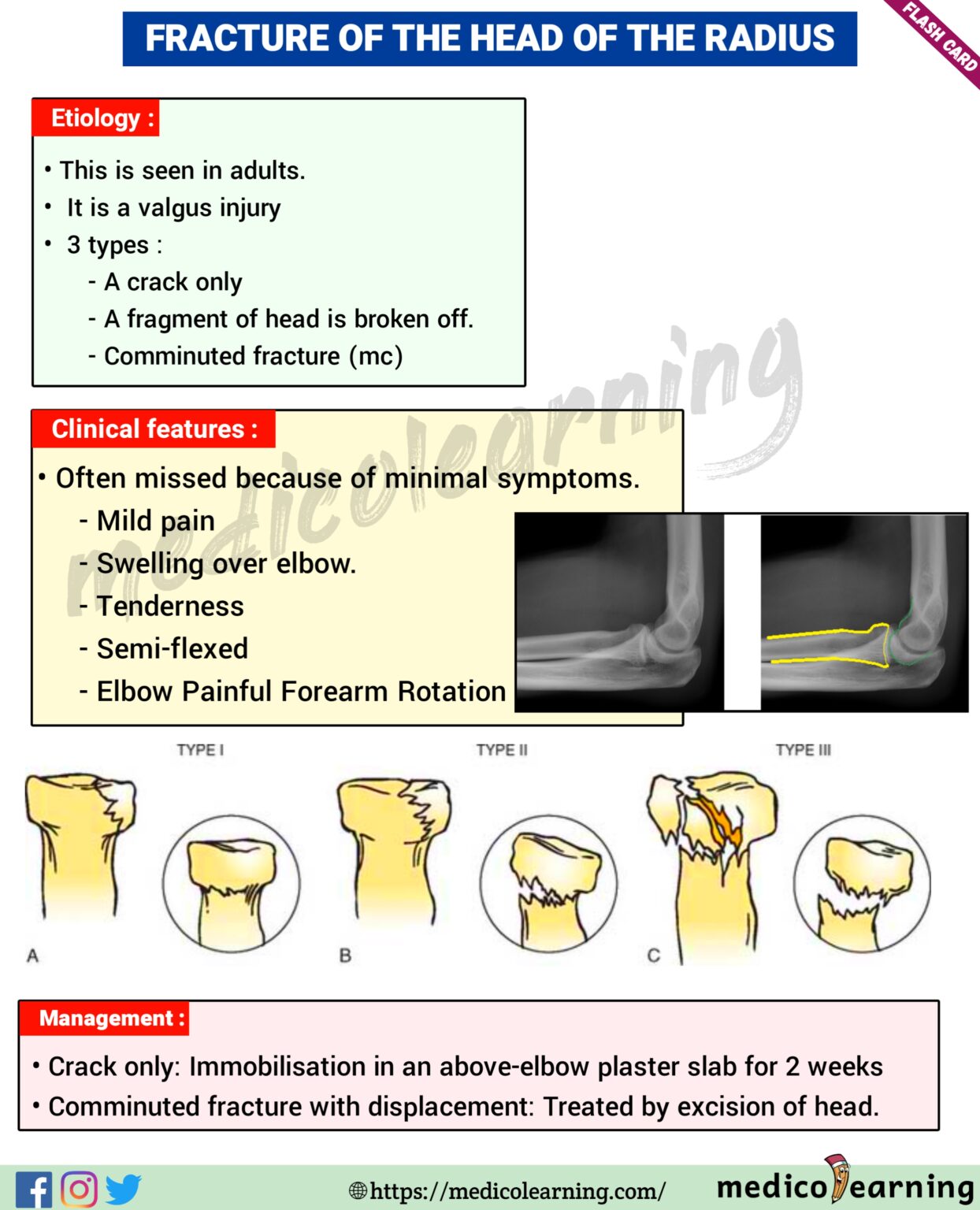 Type 2 Radial Head Fracture Recovery Time