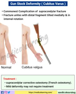 Read more about the article Cubitus varus (gunstock deformity)