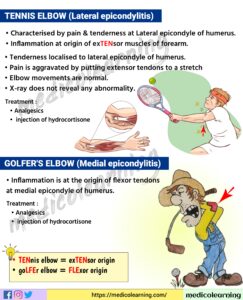 Read more about the article Tennis elbow