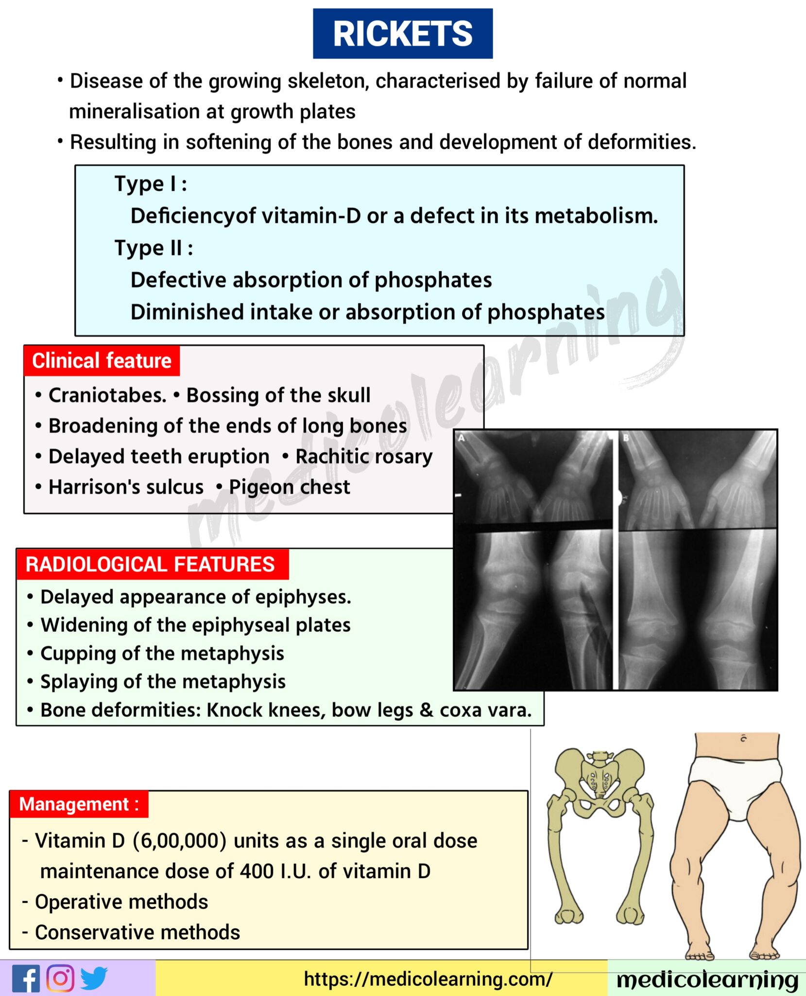 Cubitus varus (gunstock deformity) MedicoLearning